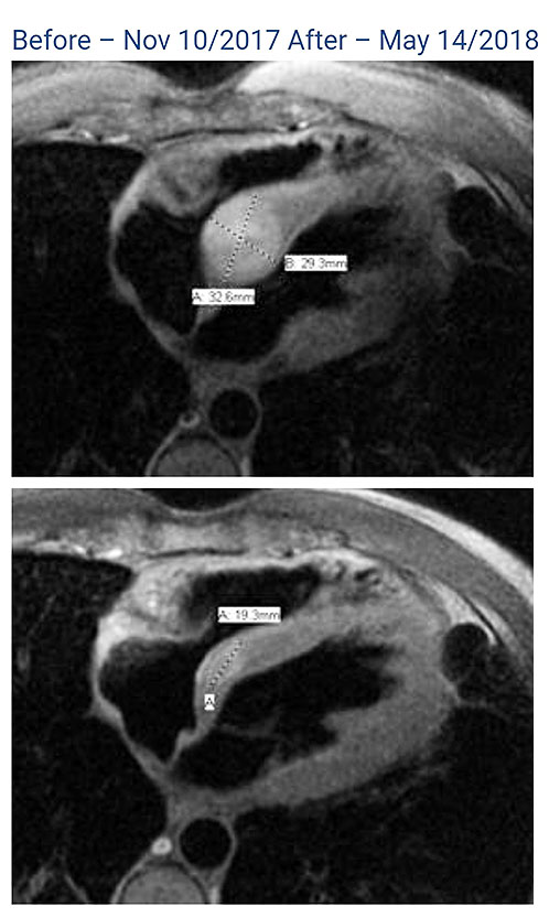 heart_tumor_5months.jpg